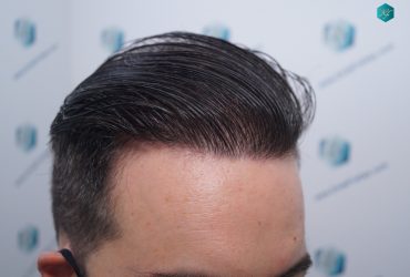 Injerto Capilar Técnica FUE 6557 Grafts (14215 Pelos) 69 89 EN 12 MESES