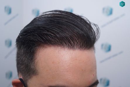 Injerto Capilar Técnica FUE 6557 Grafts (14215 Pelos) 71 89 EN 12 MESES