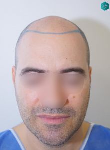 Injerto Capilar Técnica FUE 6557 Grafts (14215 Pelos) 7 9 DISEÑO 1