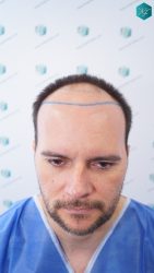 DISEÑO LINEA INJERTO CAPILAR DISEÑO LINEA INJERTO CAPILAR