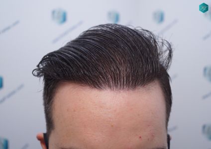 Injerto Capilar Técnica FUE 6557 Grafts (14215 Pelos) 72 93 EN 12 MESES