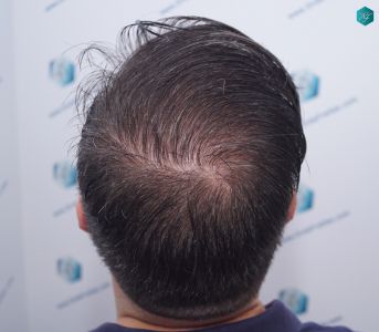 Injerto Capilar Técnica FUE 6557 Grafts (14215 Pelos) 73 95 EN 12 MESES