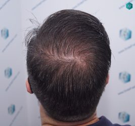 Injerto Capilar Técnica FUE 6557 Grafts (14215 Pelos) 72 96 EN 12 MESES