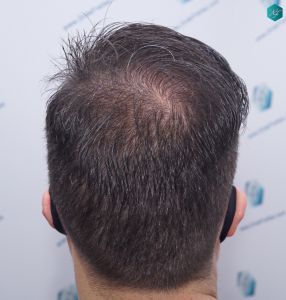 Injerto Capilar Técnica FUE 6557 Grafts (14215 Pelos) 75 97 EN 12 MESES
