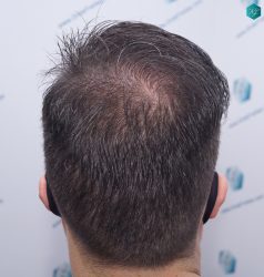 Injerto Capilar Técnica FUE 6557 Grafts (14215 Pelos) 73 97 EN 12 MESES