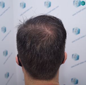 Injerto Capilar Técnica FUE 6557 Grafts (14215 Pelos) 76 98 EN 12 MESES