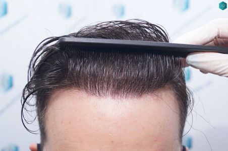 Injerto Capilar Técnica FUE 6557 Grafts (14215 Pelos) 77 99 EN 12 MESES
