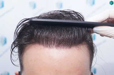 Injerto Capilar Técnica FUE 6557 Grafts (14215 Pelos) 75 99 EN 12 MESES