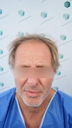 ANTES DEL TRASPLANTE CAPILAR 1 ANTES DEL TRASPLANTE CAPILAR