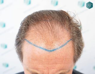 Injerto Capilar Técnica FUE Grafts 2942 (6642 Pelos) 11 10 ANTES DEL TRASPLANTE CAPILAR