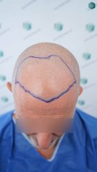 Injerto Capilar Técnica FUE Grafts 2942 (6642 Pelos) 13 12 ANTES DEL TRASPLANTE CAPILAR