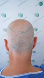 Injerto Capilar Técnica FUE Grafts 2942 (6642 Pelos) 14 13 ANTES DEL TRASPLANTE CAPILAR