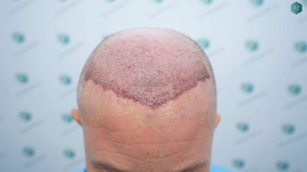 Injerto Capilar Técnica FUE Grafts 2942 (6642 Pelos) 15 15 TRASPLANTE CAPILAR