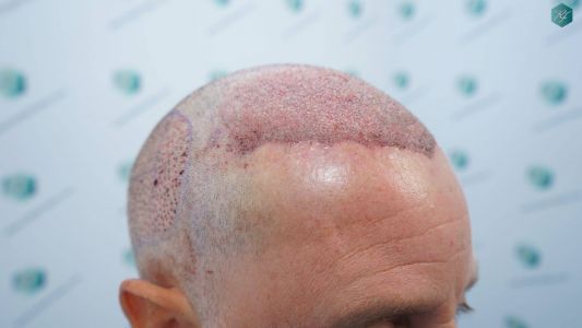 Injerto Capilar Técnica FUE Grafts 2942 (6642 Pelos) 16 16 TRASPLANTE CAPILAR