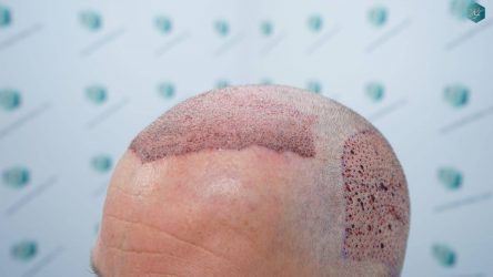 Injerto Capilar Técnica FUE Grafts 2942 (6642 Pelos) 17 17 TRASPLANTE CAPILAR