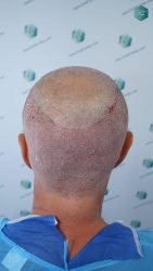 Injerto Capilar Técnica FUE Grafts 2942 (6642 Pelos) 18 18 TRASPLANTE CAPILAR