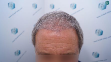 RESULTADOS A LOS 3 MESES 19 RESULTADOS A LOS 3 MESES