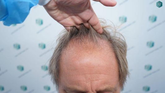 Injerto Capilar Técnica FUE Grafts 2942 (6642 Pelos) 1 2 ANTES DEL TRASPLANTE CAPILAR