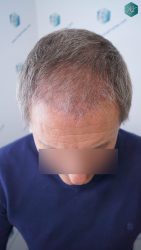 Injerto Capilar Técnica FUE Grafts 2942 (6642 Pelos) 19 20 RESULTADOS A LOS 3 MESES