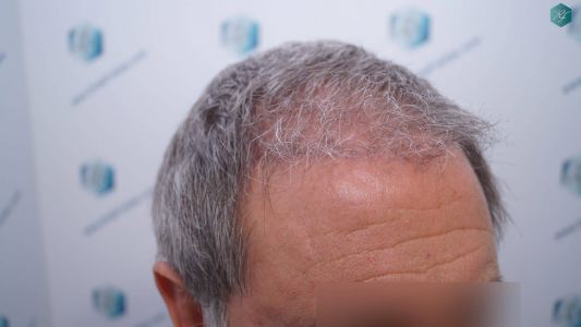 Injerto Capilar Técnica FUE Grafts 2942 (6642 Pelos) 20 21 RESULTADOS A LOS 3 MESES 1 1