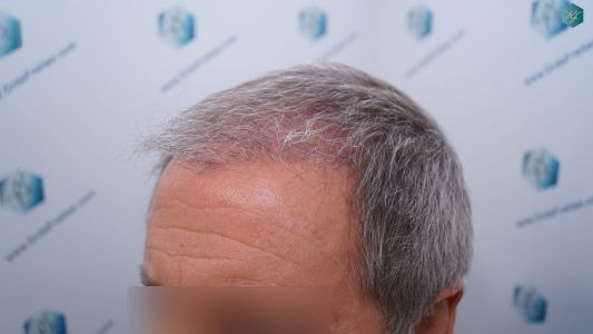 Injerto Capilar Técnica FUE Grafts 2942 (6642 Pelos) 21 22 RESULTADOS A LOS 3 MESES