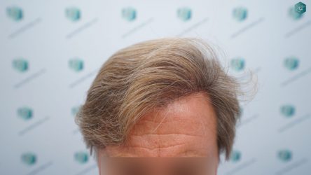 Injerto Capilar Técnica FUE Grafts 2942 (6642 Pelos) 22 24 RESULTADOS A LOS 12 MESES