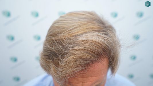 Injerto Capilar Técnica FUE Grafts 2942 (6642 Pelos) 23 25 RESULTADOS A LOS 12 MESES