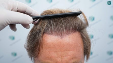 Injerto Capilar Técnica FUE Grafts 2942 (6642 Pelos) 25 26A RESULTADOS A LOS 12 MESES