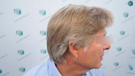 Injerto Capilar Técnica FUE Grafts 2942 (6642 Pelos) 26 26B RESULTADOS A LOS 12 MESES