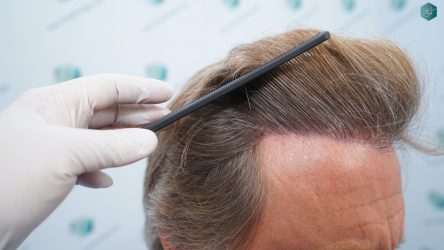 Injerto Capilar Técnica FUE Grafts 2942 (6642 Pelos) 27 27 RESULTADOS A LOS 12 MESES