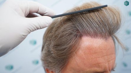 Injerto Capilar Técnica FUE Grafts 2942 (6642 Pelos) 30 29 RESULTADOS A LOS 12 MESES