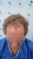 Injerto Capilar Técnica FUE Grafts 2942 (6642 Pelos) 4 3 ANTES DEL TRASPLANTE CAPILAR