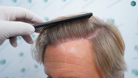 Injerto Capilar Técnica FUE Grafts 2942 (6642 Pelos) 29 30 RESULTADOS A LOS 12 MESES