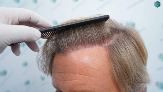 Injerto Capilar Técnica FUE Grafts 2942 (6642 Pelos) 29 30 RESULTADOS A LOS 12 MESES