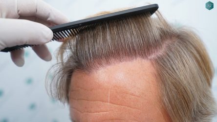 Injerto Capilar Técnica FUE Grafts 2942 (6642 Pelos) 31 31 RESULTADOS A LOS 12 MESES