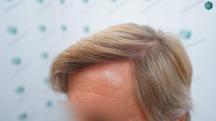 Injerto Capilar Técnica FUE Grafts 2942 (6642 Pelos) 33 32 RESULTADOS A LOS 12 MESES