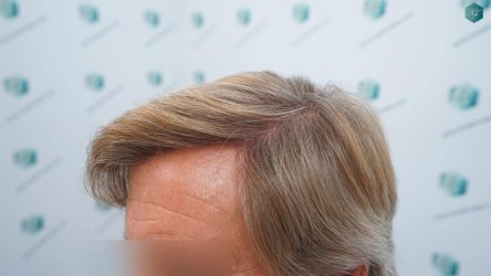 Injerto Capilar Técnica FUE Grafts 2942 (6642 Pelos) 32 33 RESULTADOS A LOS 12 MESES