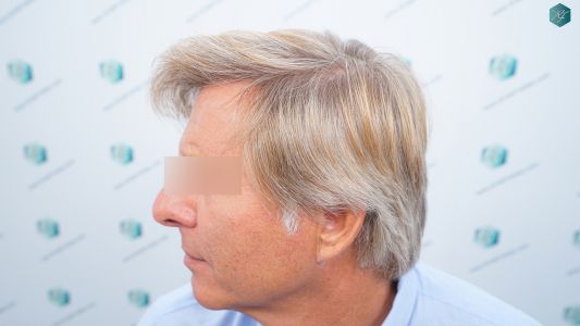 Injerto Capilar Técnica FUE Grafts 2942 (6642 Pelos) 34 34 RESULTADOS A LOS 12 MESES