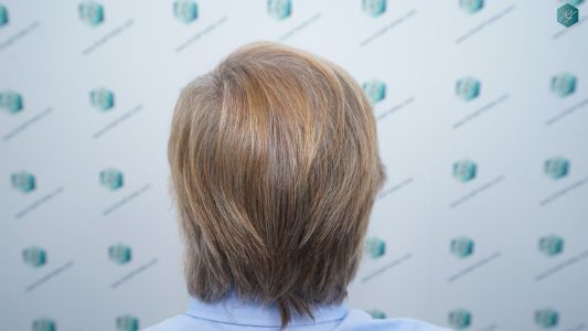 Injerto Capilar Técnica FUE Grafts 2942 (6642 Pelos) 35 35 RESULTADOS A LOS 12 MESES