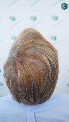 Injerto Capilar Técnica FUE Grafts 2942 (6642 Pelos) 34 36 RESULTADOS A LOS 12 MESES