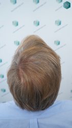 Injerto Capilar Técnica FUE Grafts 2942 (6642 Pelos) 35 37 RESULTADOS A LOS 12 MESES DSC03095