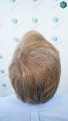 Injerto Capilar Técnica FUE Grafts 2942 (6642 Pelos) 36 38 RESULTADOS A LOS 12 MESES