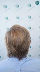 Injerto Capilar Técnica FUE Grafts 2942 (6642 Pelos) 37 39 RESULTADOS A LOS 12 MESES