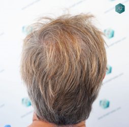 Injerto Capilar Técnica FUE Grafts 2942 (6642 Pelos) 6 3A ANTES DEL TRASPLANTE CAPILAR