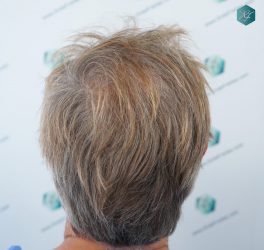 Injerto Capilar Técnica FUE Grafts 2942 (6642 Pelos) 5 3B- ANTES DEL TRASPLANTE CAPILAR