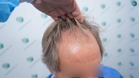 ANTES DEL TRASPLANTE CAPILAR 4 ANTES DEL TRASPLANTE CAPILAR