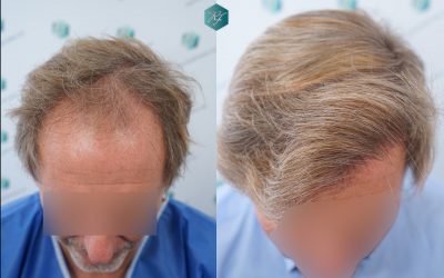 Injerto Capilar Técnica FUE Grafts 2942 (6642 Pelos) 38 41 COMPARATIVAS