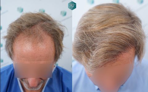 Injerto Capilar Técnica FUE Grafts 2942 (6642 Pelos) 40 41 COMPARATIVAS