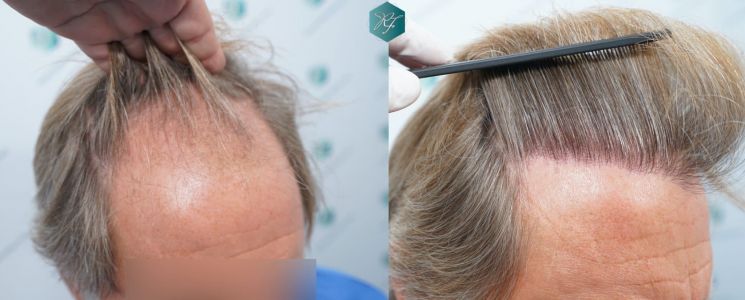 Injerto Capilar Técnica FUE Grafts 2942 (6642 Pelos) 41 42 COMPARATIVAS