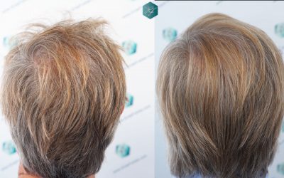 Injerto Capilar Técnica FUE Grafts 2942 (6642 Pelos) 40 44 COMPARATIVAS